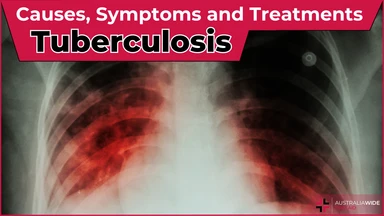 Tuberculosis article header – First Aid Article in Ballajura